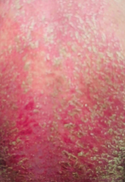 Erythrodermic Psoriasis